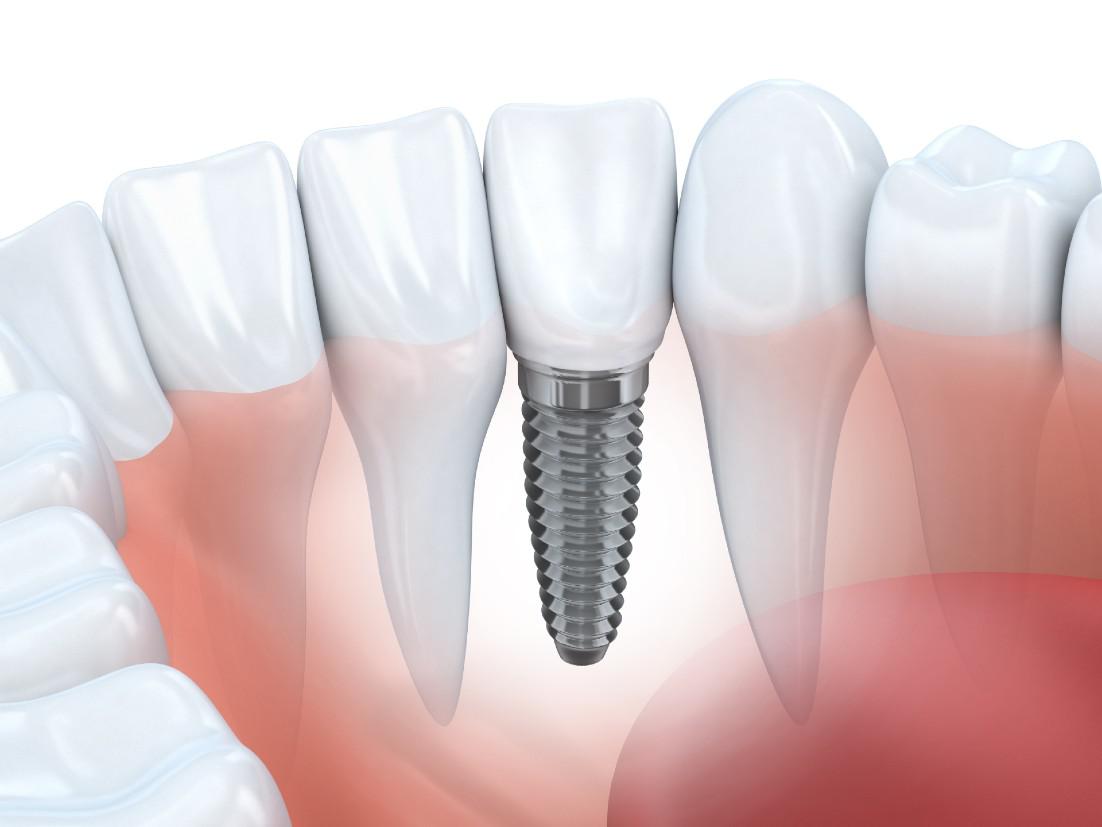 Dental Implants Woodland Hills, CA